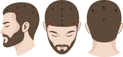 پیشنمایش ناحیه و شدت ریزش