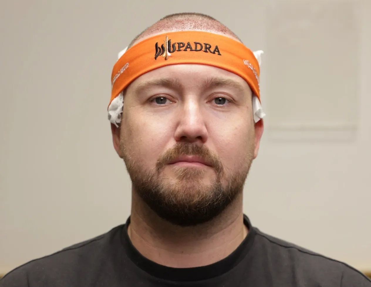 hair transplant1day