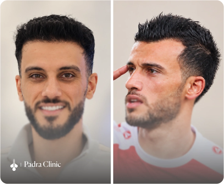 hair transplant for Omar Al Somah in padra clinic